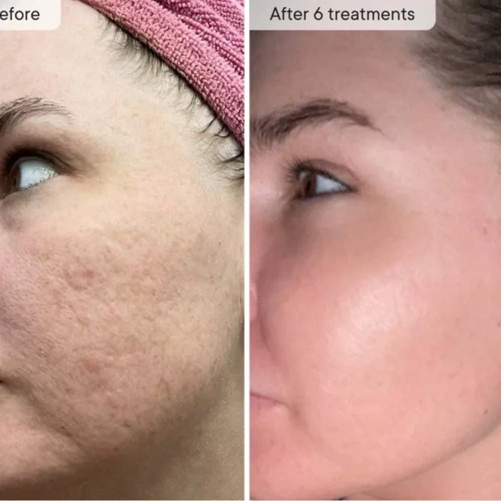 Micro-Infusion Facial System - Qure 2 month supply. Dark spot serum. See descr - Picture 4 of 4